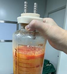 阿拉尔水动力吸脂手术要做多久？